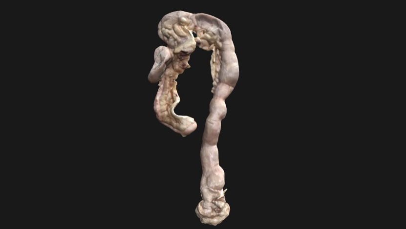 intestino-grosso